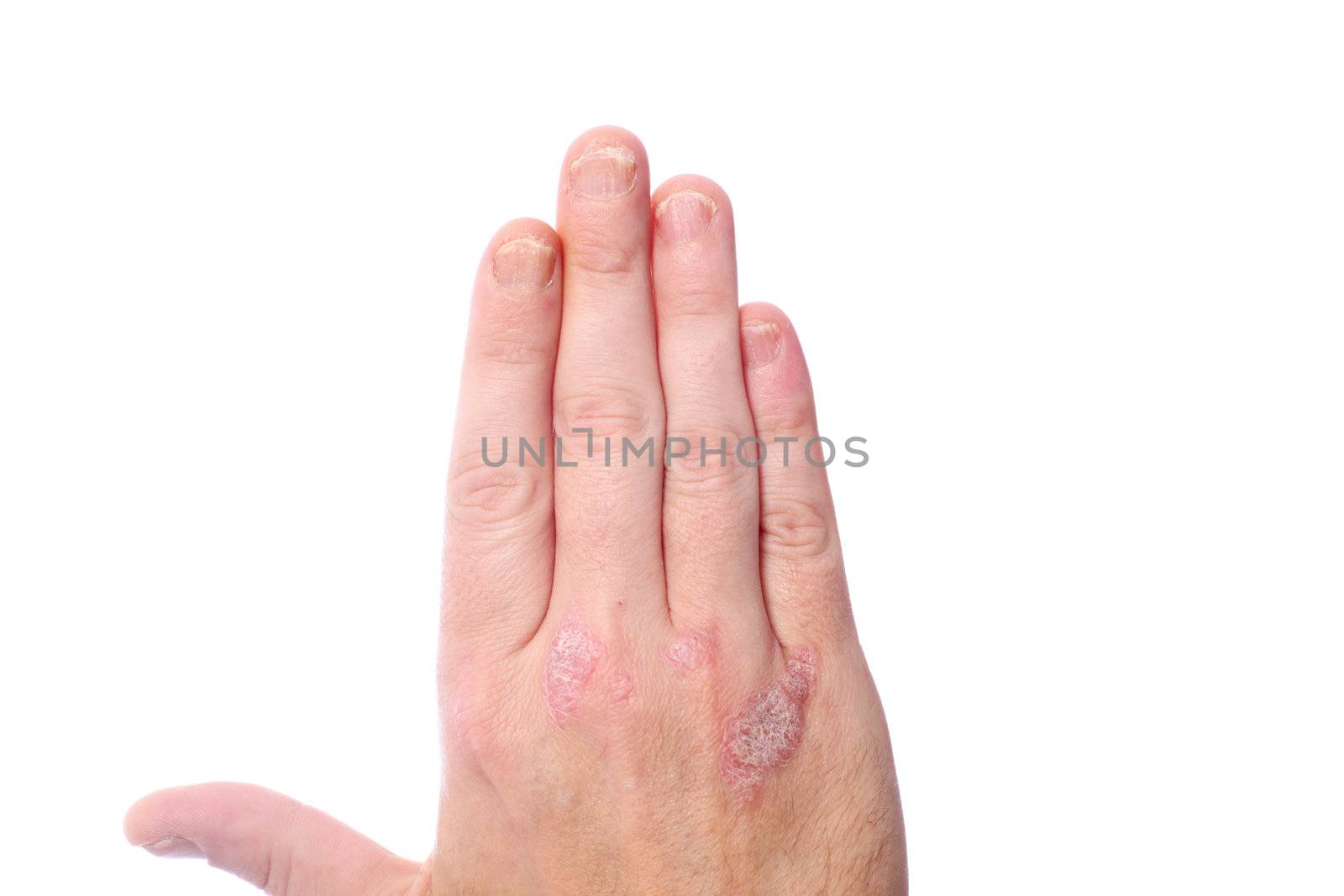 psoriasis on the hands and fingernails - Close-up