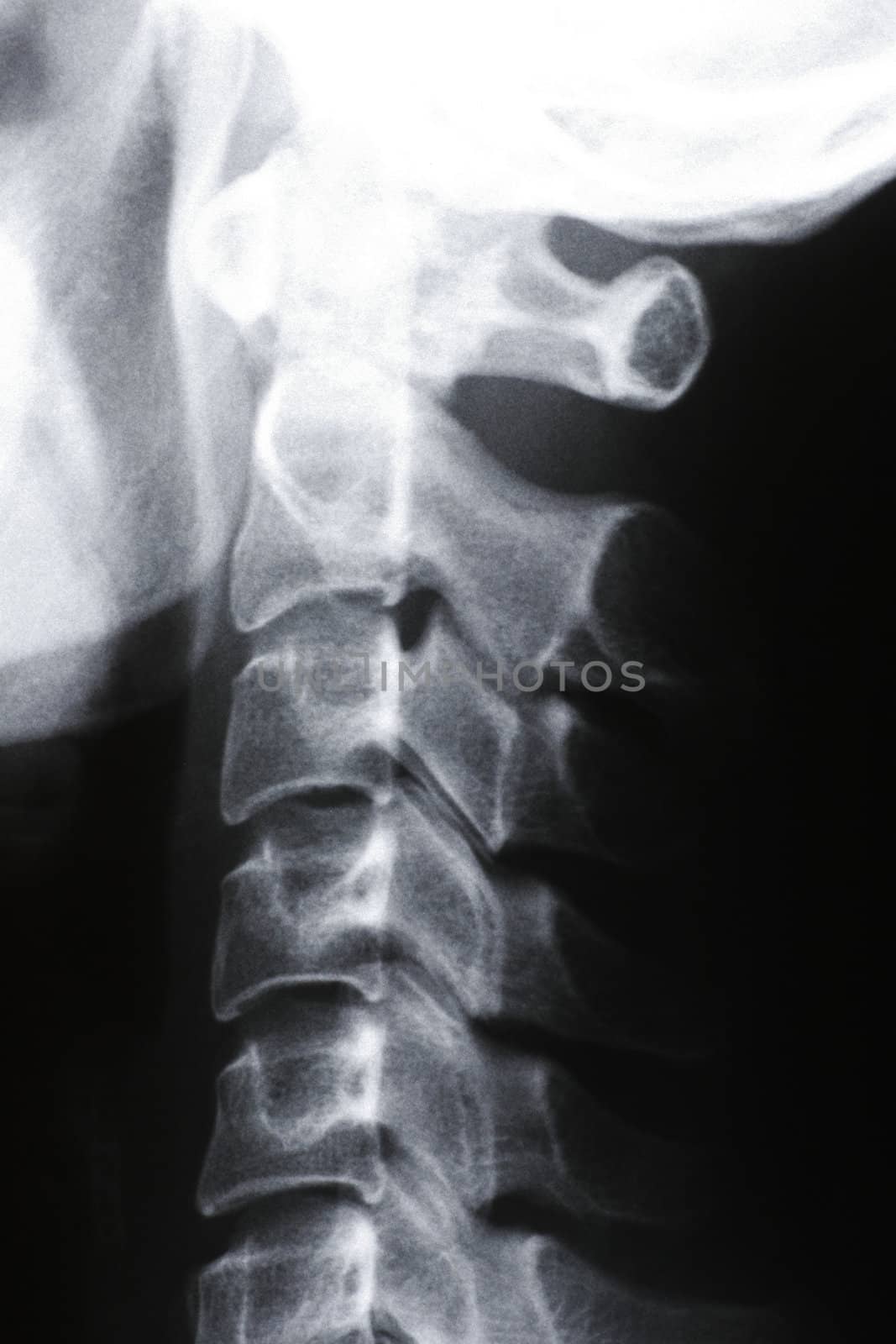 Neck X-Ray by thorsten