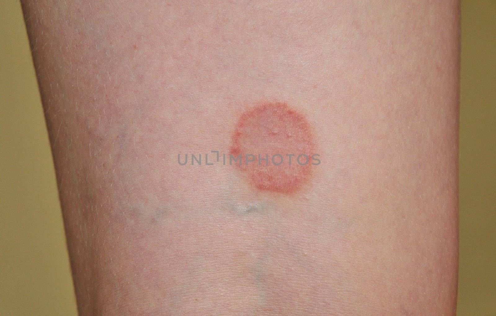 lichen ruber planus on the leg of young woman