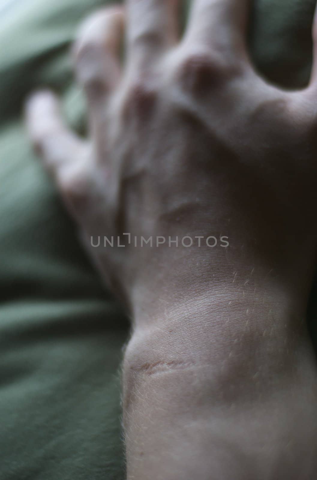 A vertical image of a scarred wrist and hand