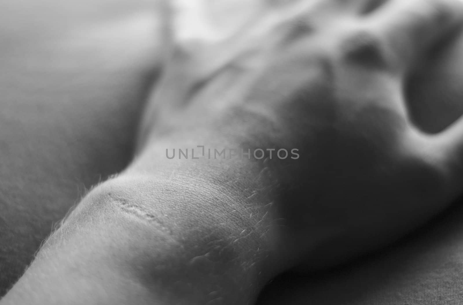 A grainy black and white image of a scarred wrist.