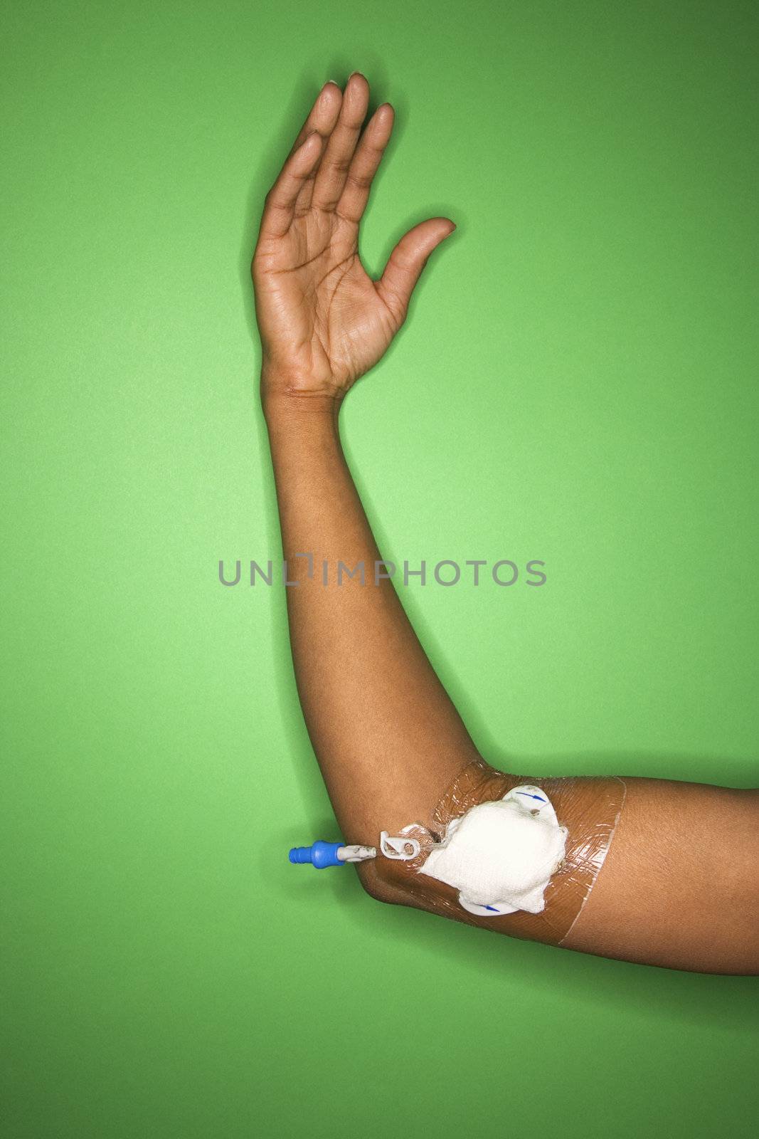 African-American female arm with bandage gauze and IV.