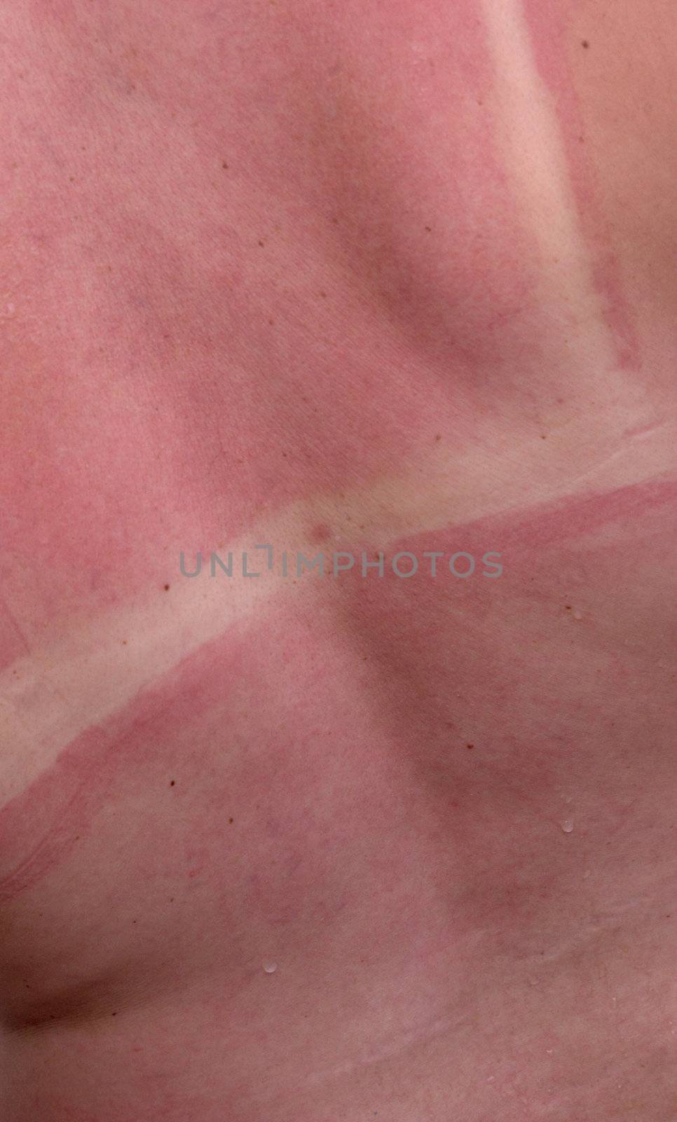 red sunburned female skin with white unsuntanned strips of skin shilded bikini