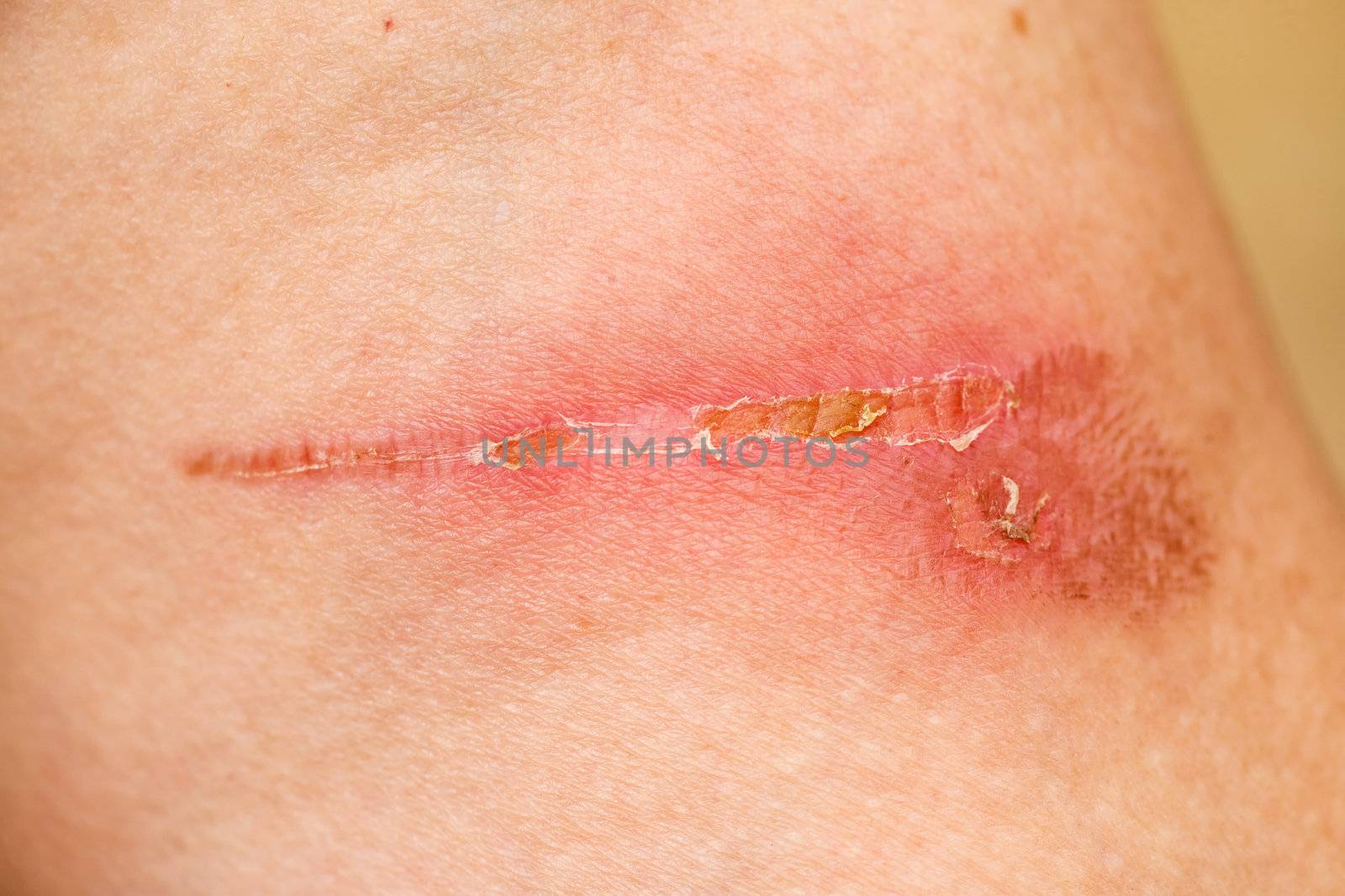 Burn Scar Detail by leaf