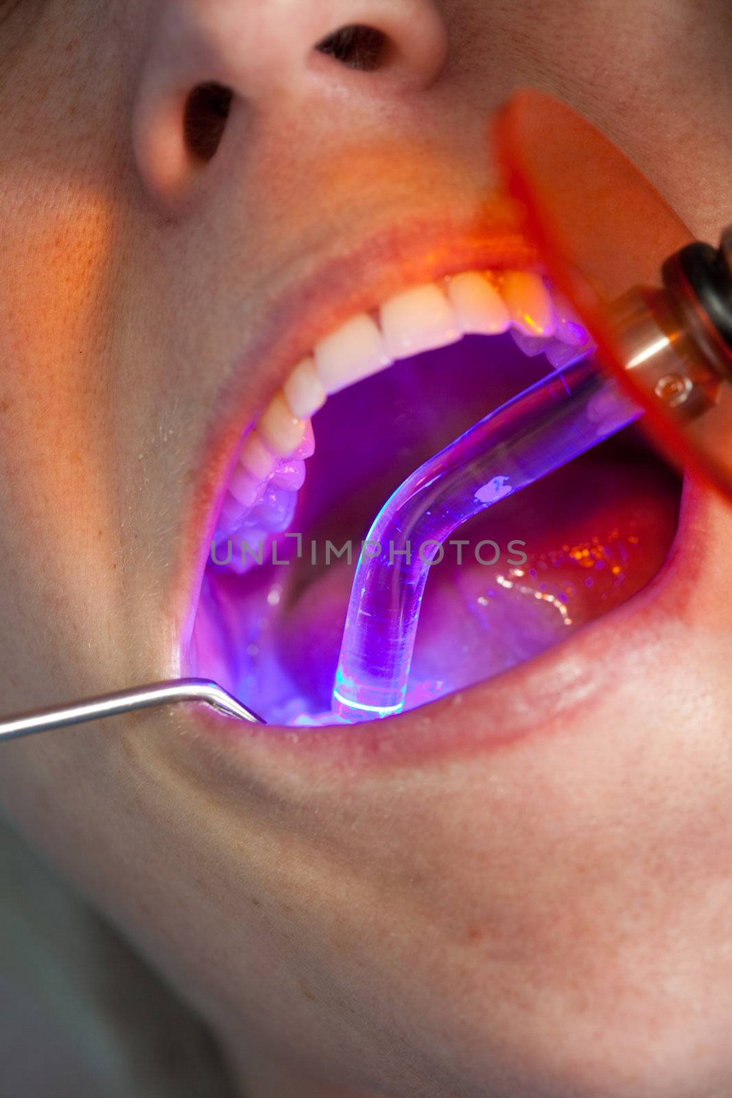 Drying of the dental filling by Fotosmurf