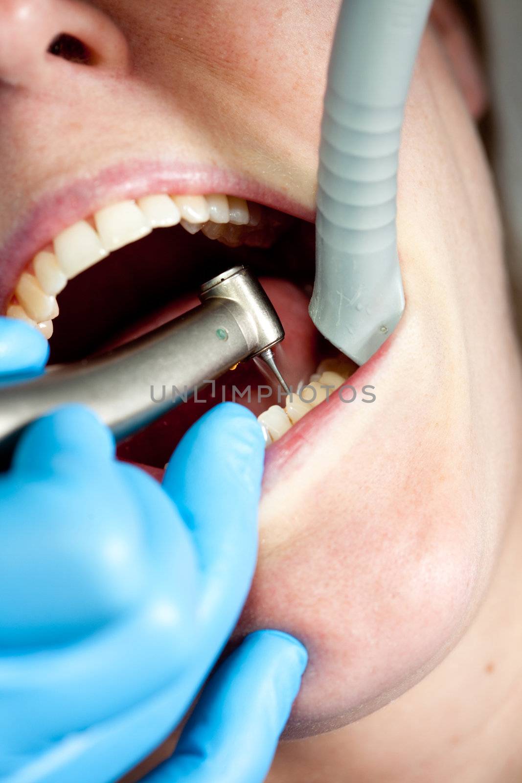 Dentist working on her patients mouth with a drill