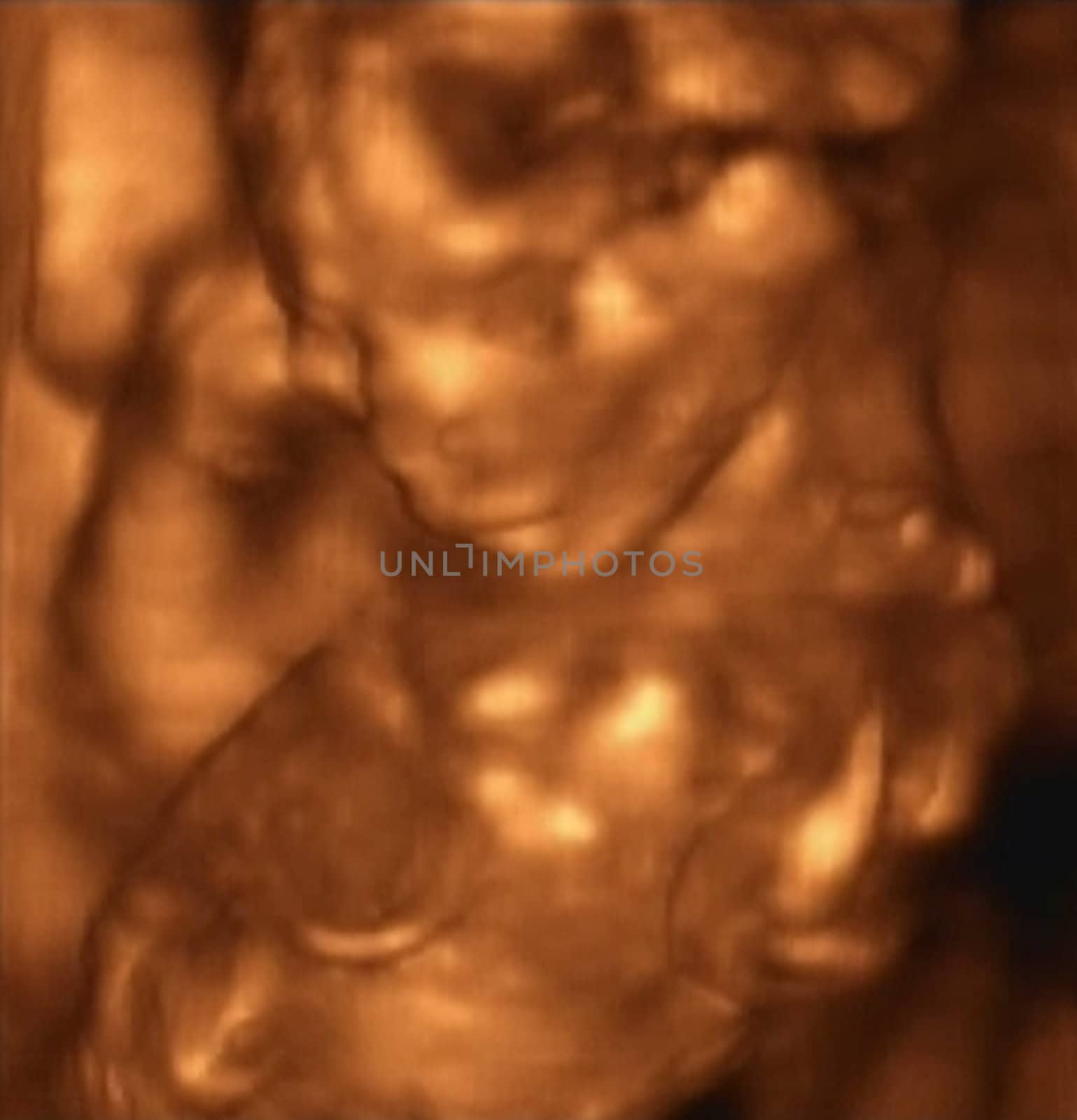 Three Dimensional Ultrasonography of Fourt Month Fetus