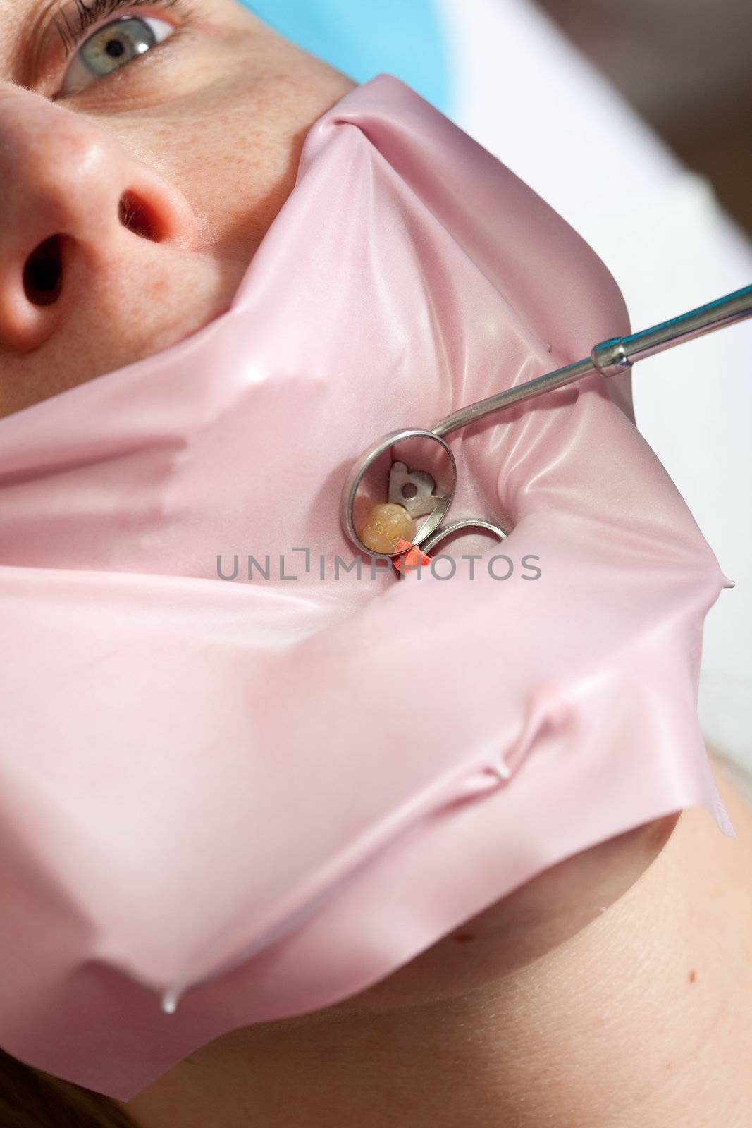 Patient lying with her mouth open with a protective silicon casing around one of her teeth