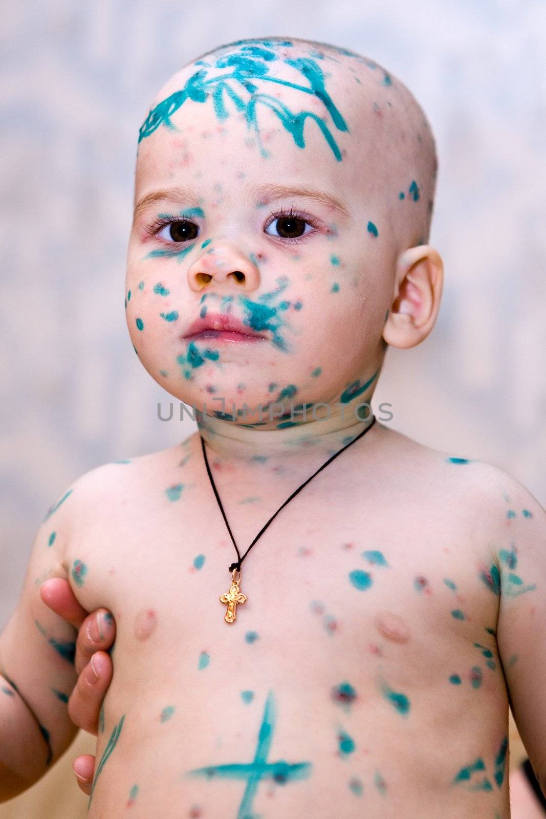 My son during illness a chicken pox 