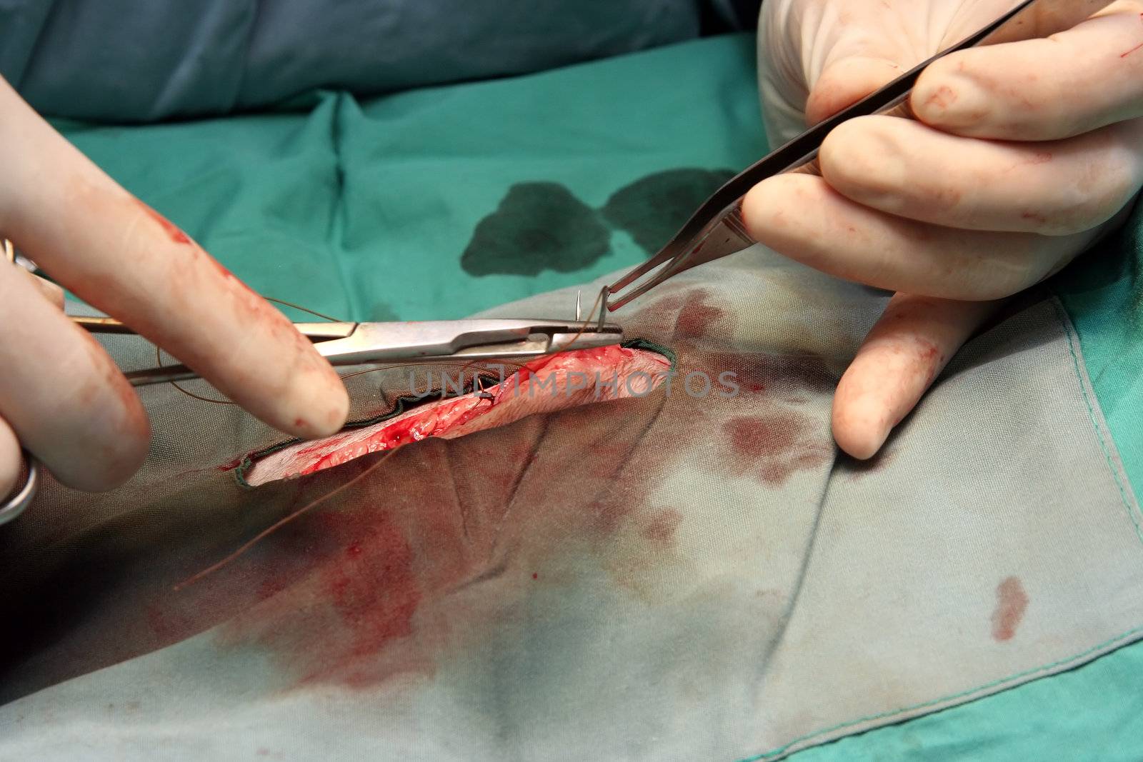 A surgeon using stitches to close a wound.