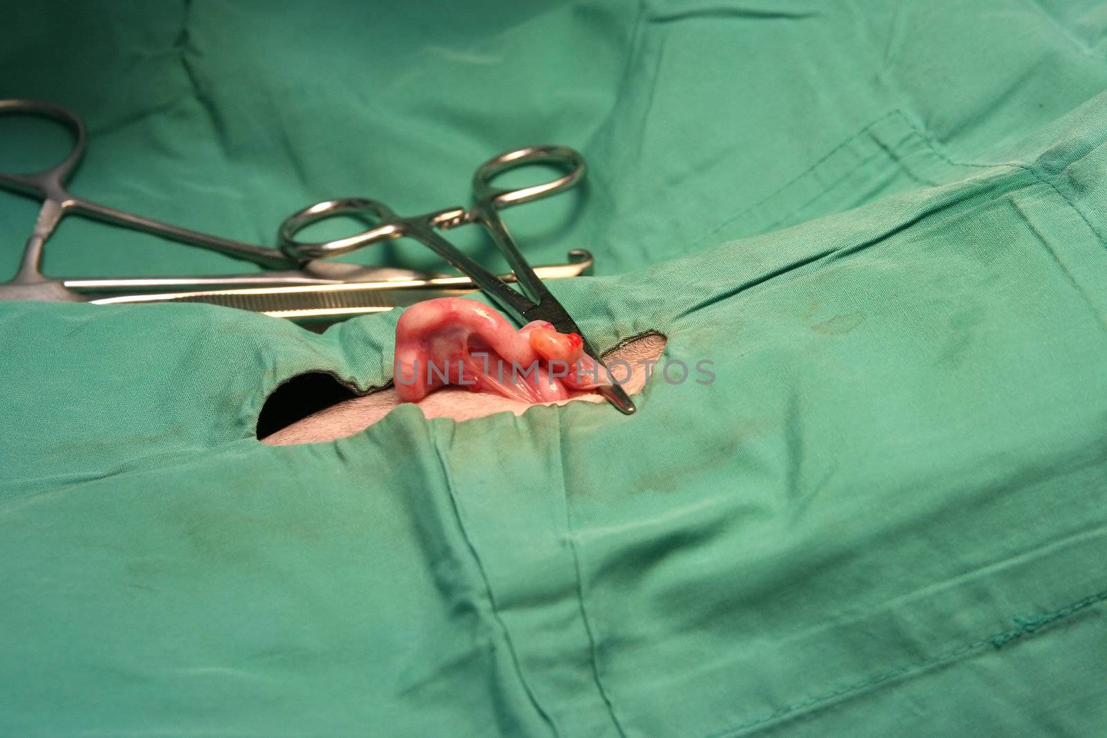 An organ clipped of during surgery