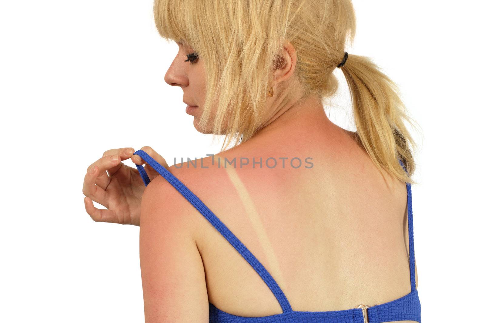 Blond female with a bad sunburn on her back.
