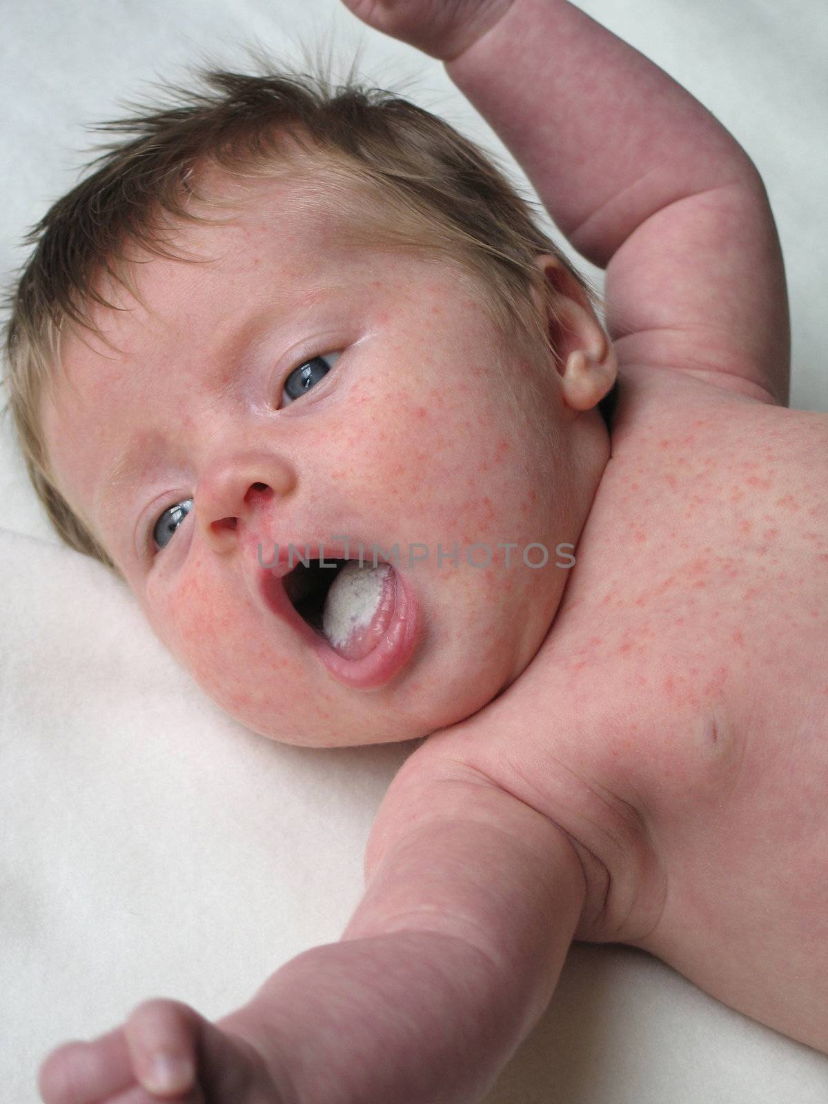 baby with a rash
