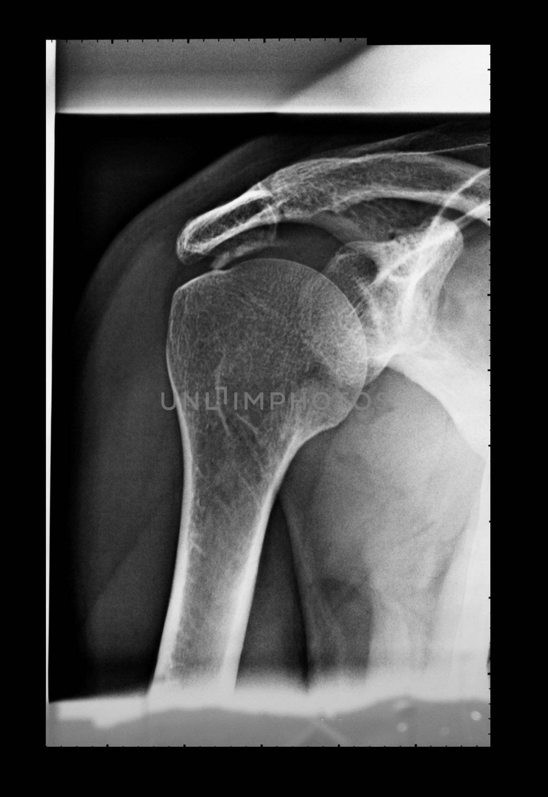 Medical X-Ray imaging of a shoulder, used in diagnostic radiology of skeleton bones