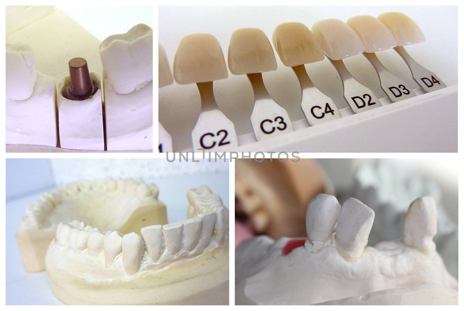 Dental technician collage with plaster mouth, implant abutment and dental shade guide