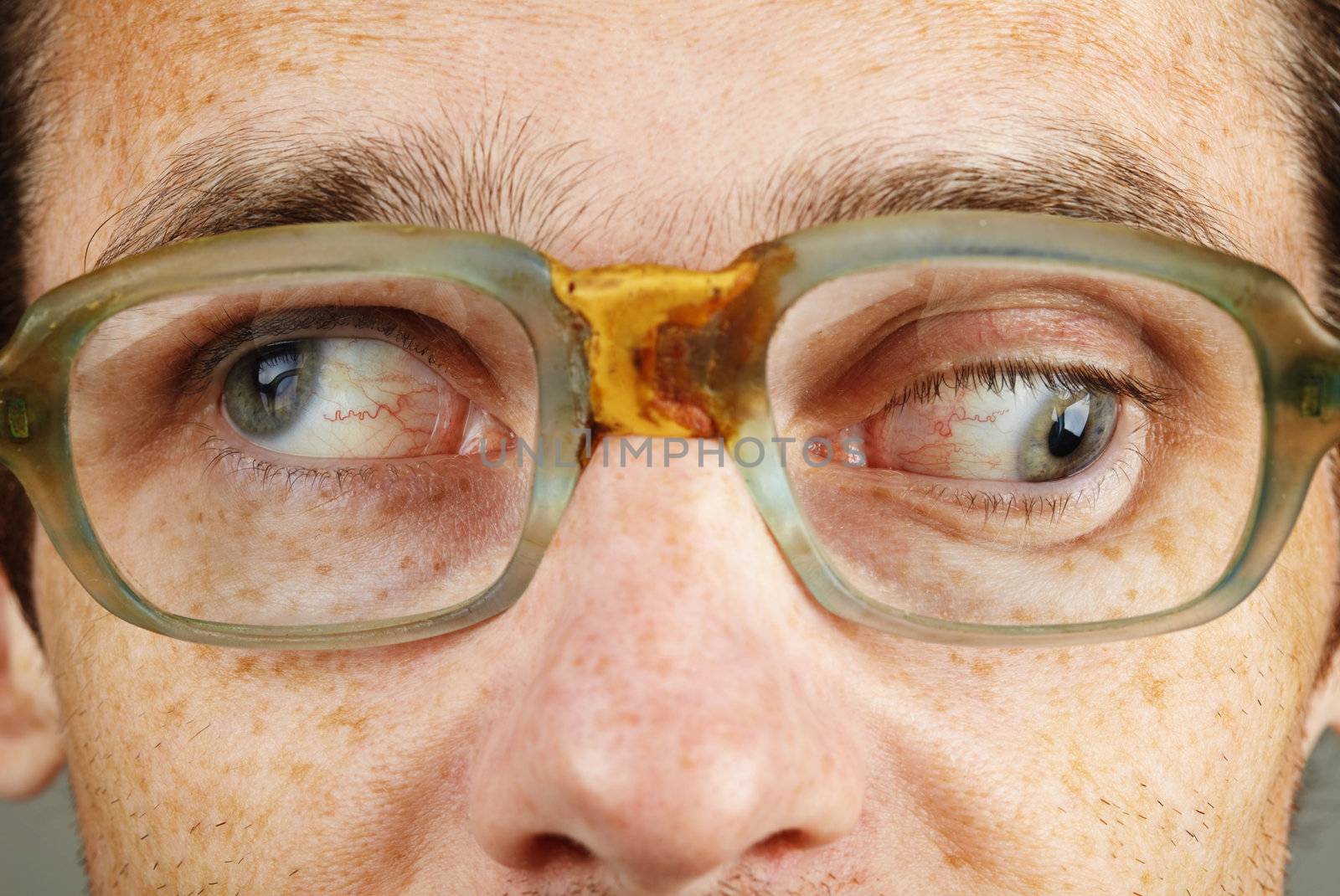 A person suffering from a severe form of strabismus - eye closeup