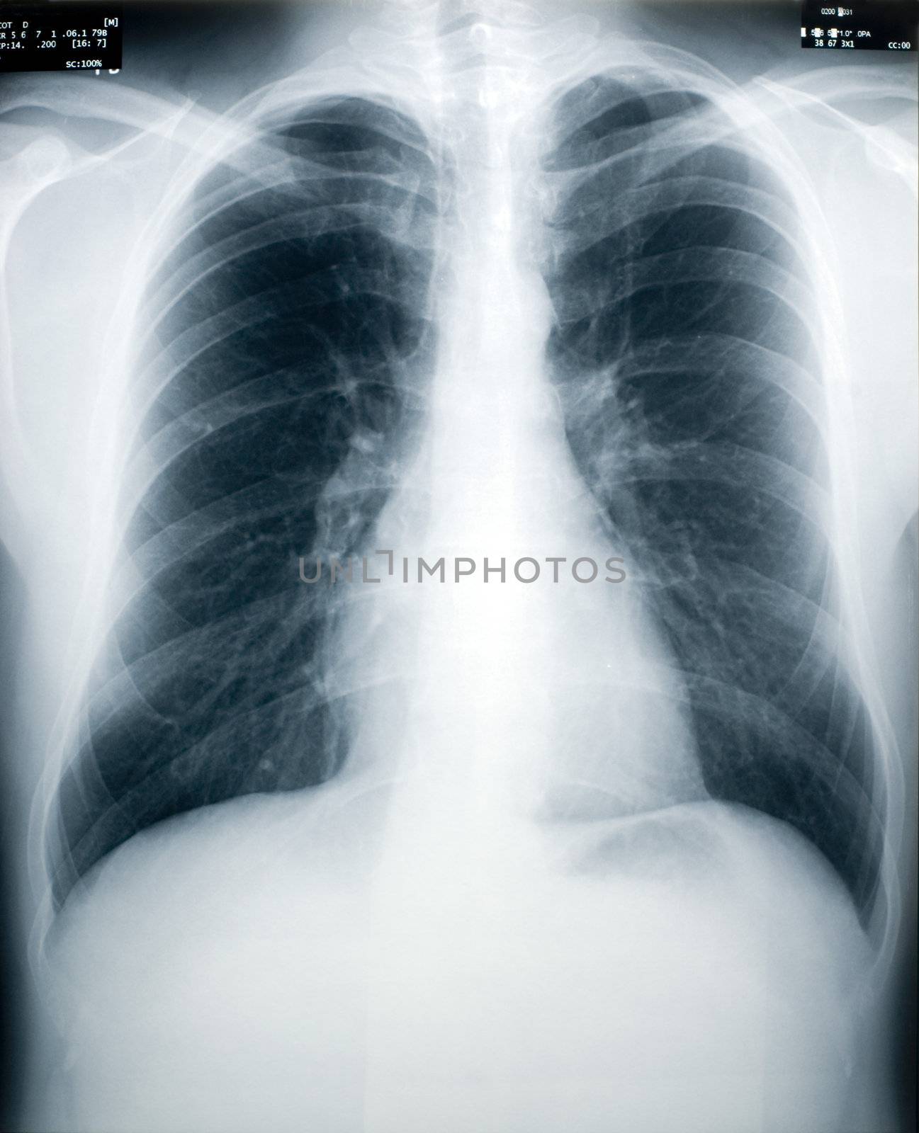 An x-ray of a healthy male chest and lungs (identity numbers and dates have the obfuscated)
