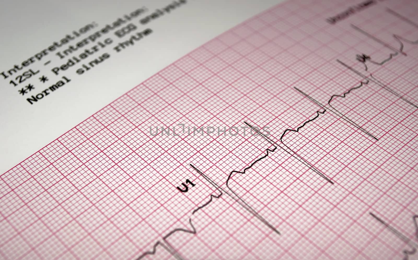 Heart analysis, ECG graph, pediatric electrocardiogram.