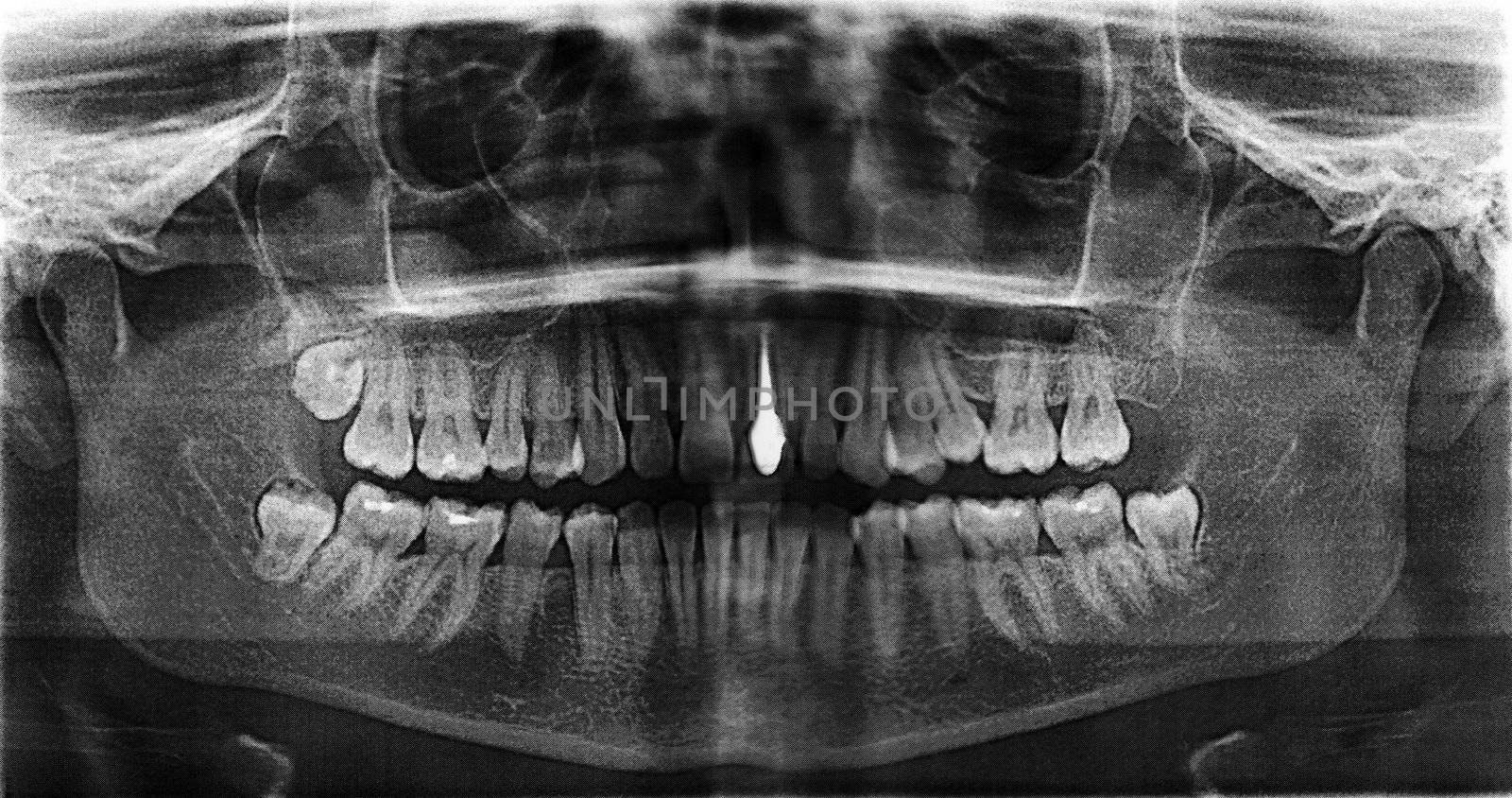 Implanted tooth on a steel pin. X-ray of female jaw. Scanned from the film
