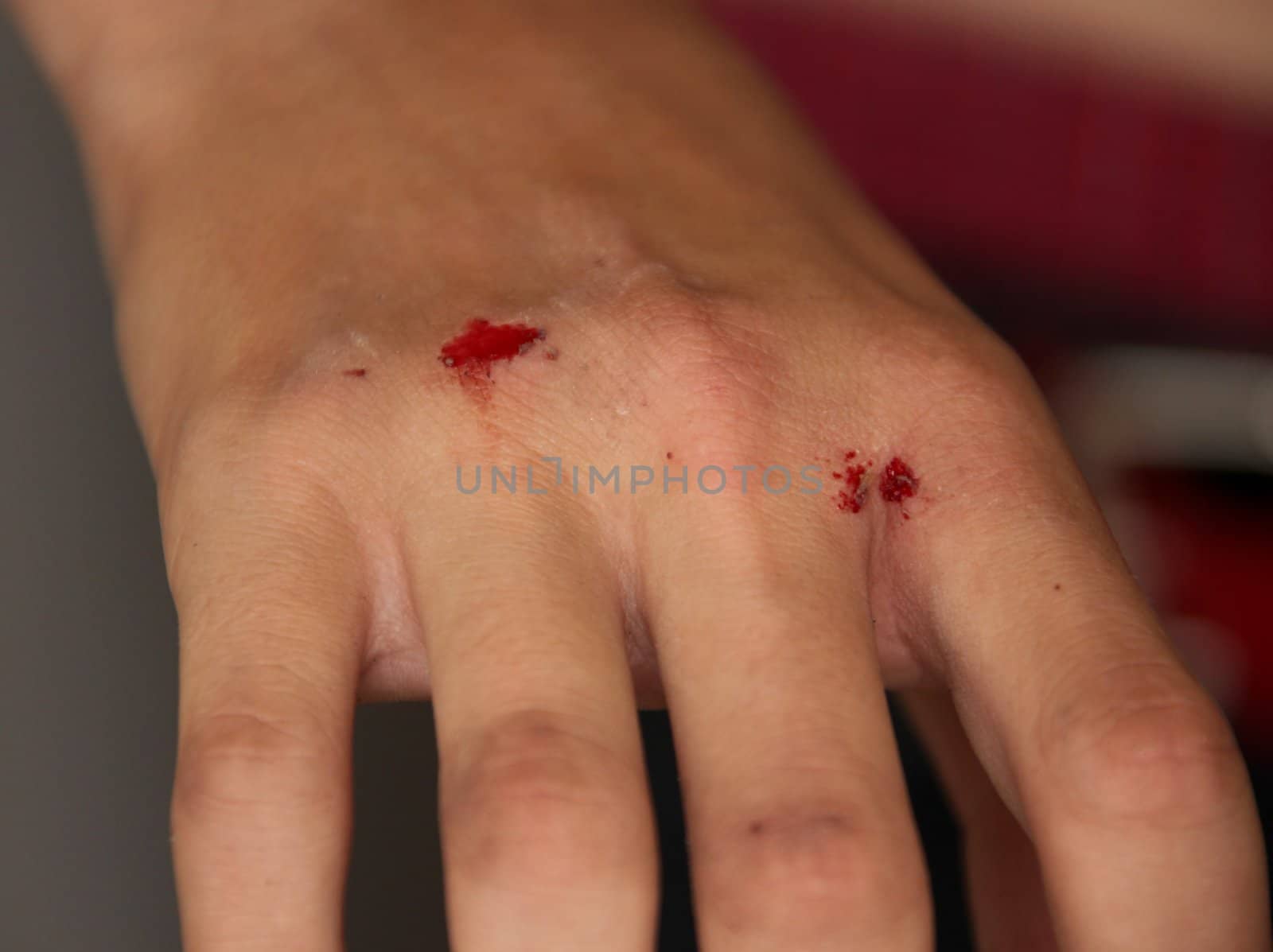 Injured Bleeding Hand of a Young Boy