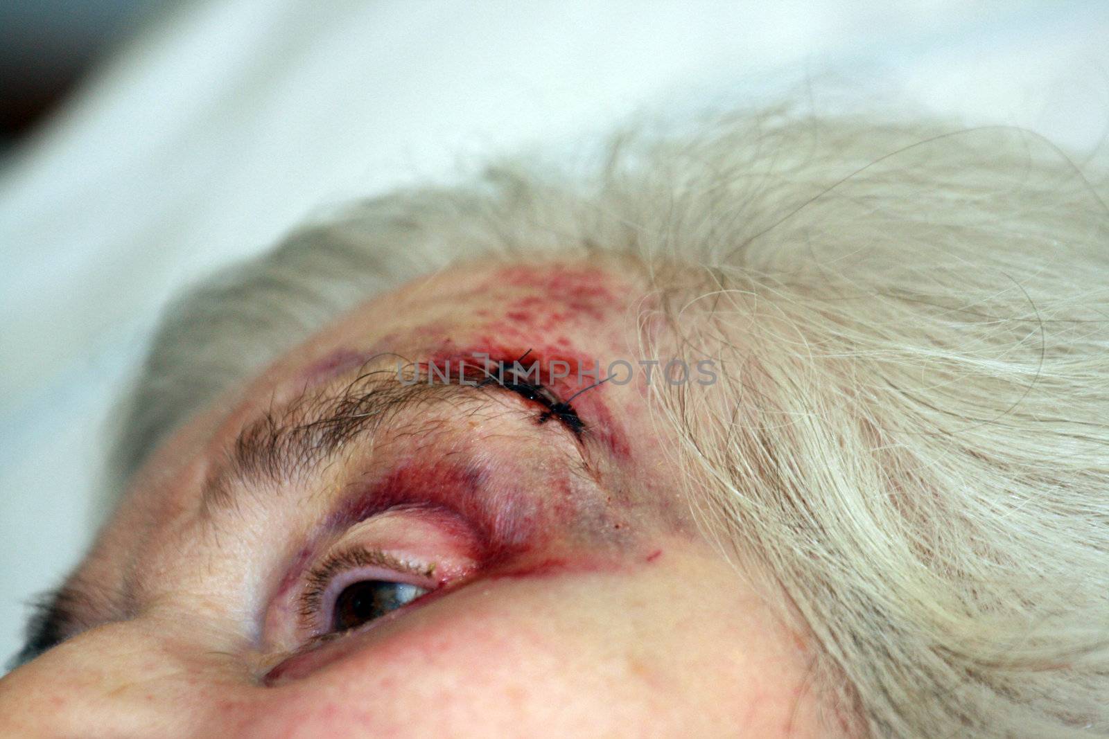 Elderly woman with stitches by keki