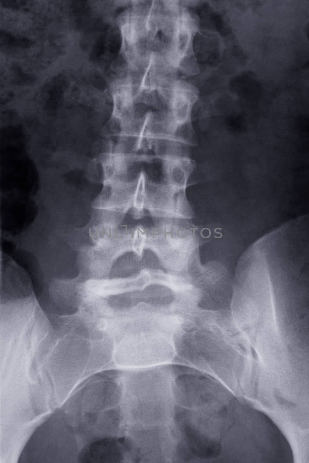 x-ray