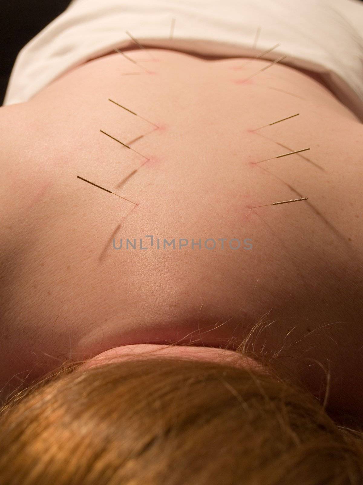 The Eastern or Asian acupuncture medical treatment said to prevent or treat a variety of medical ailments, including pain.