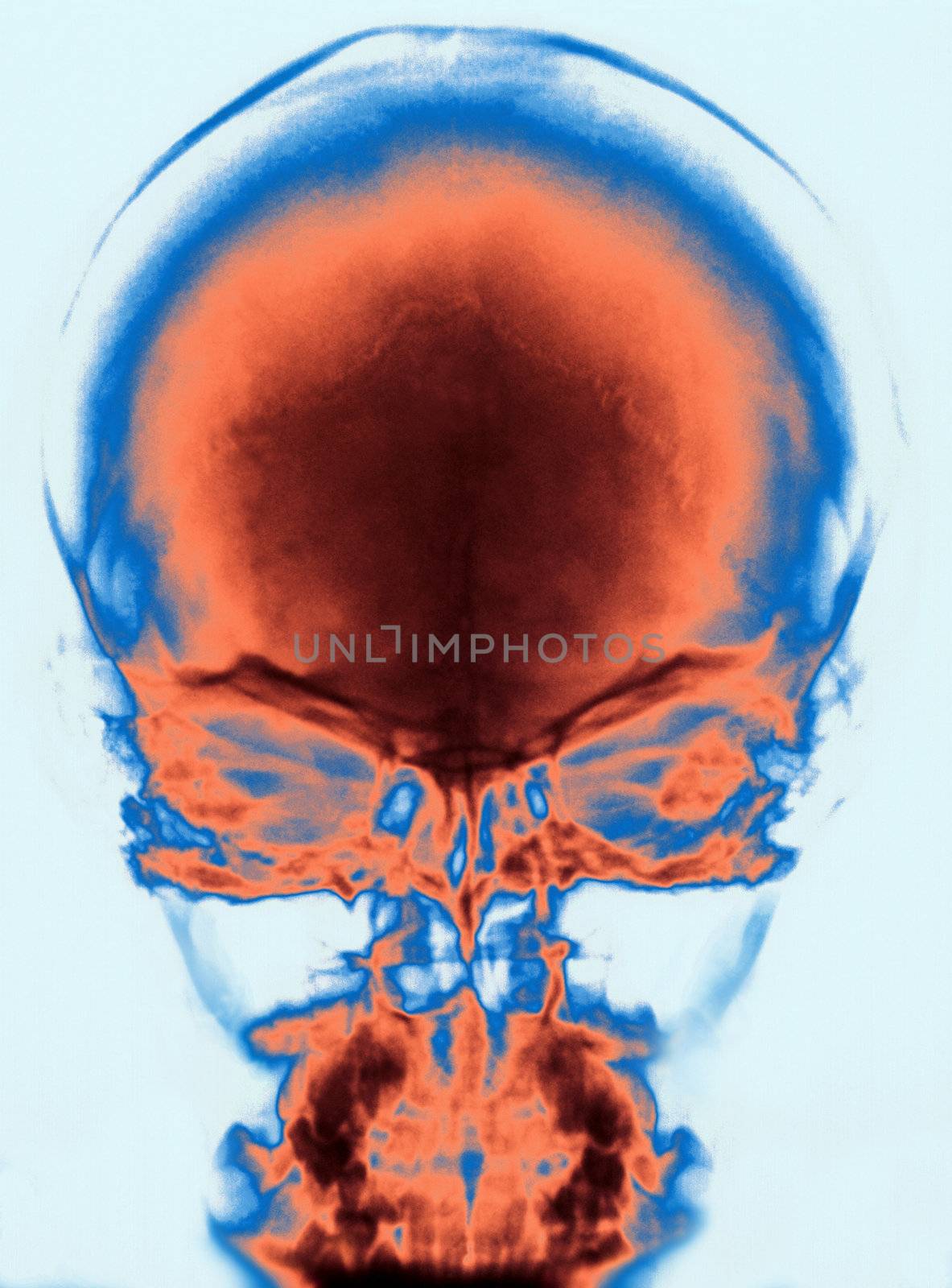 X Ray of Human Skull