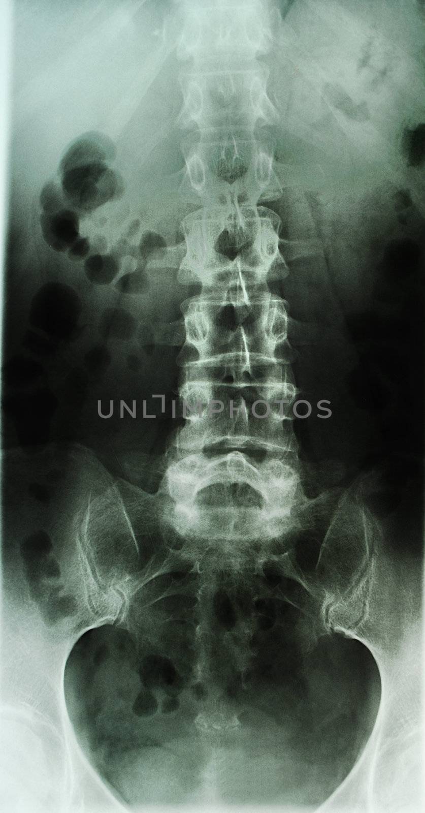 a radiograph of human body is in black and white tones