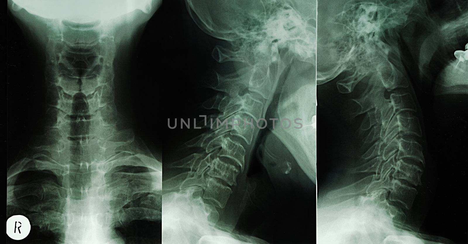 a radiograph of human body is in black and white tones