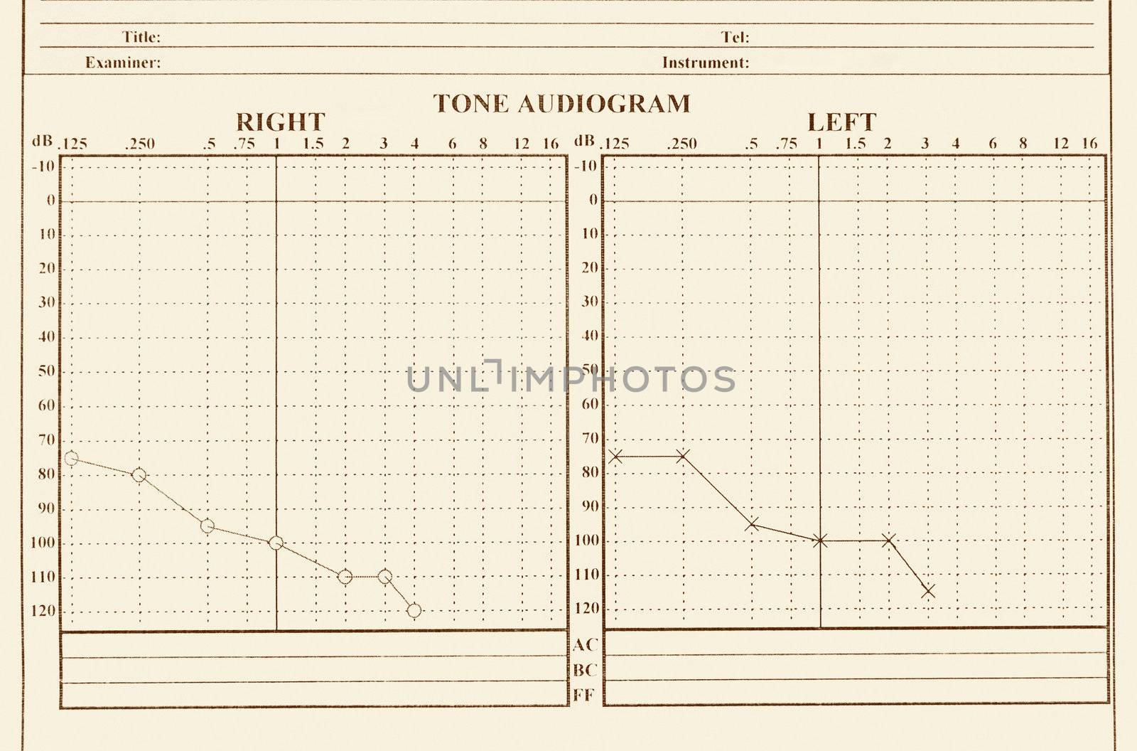 details of hearing medical chart showing, audiology