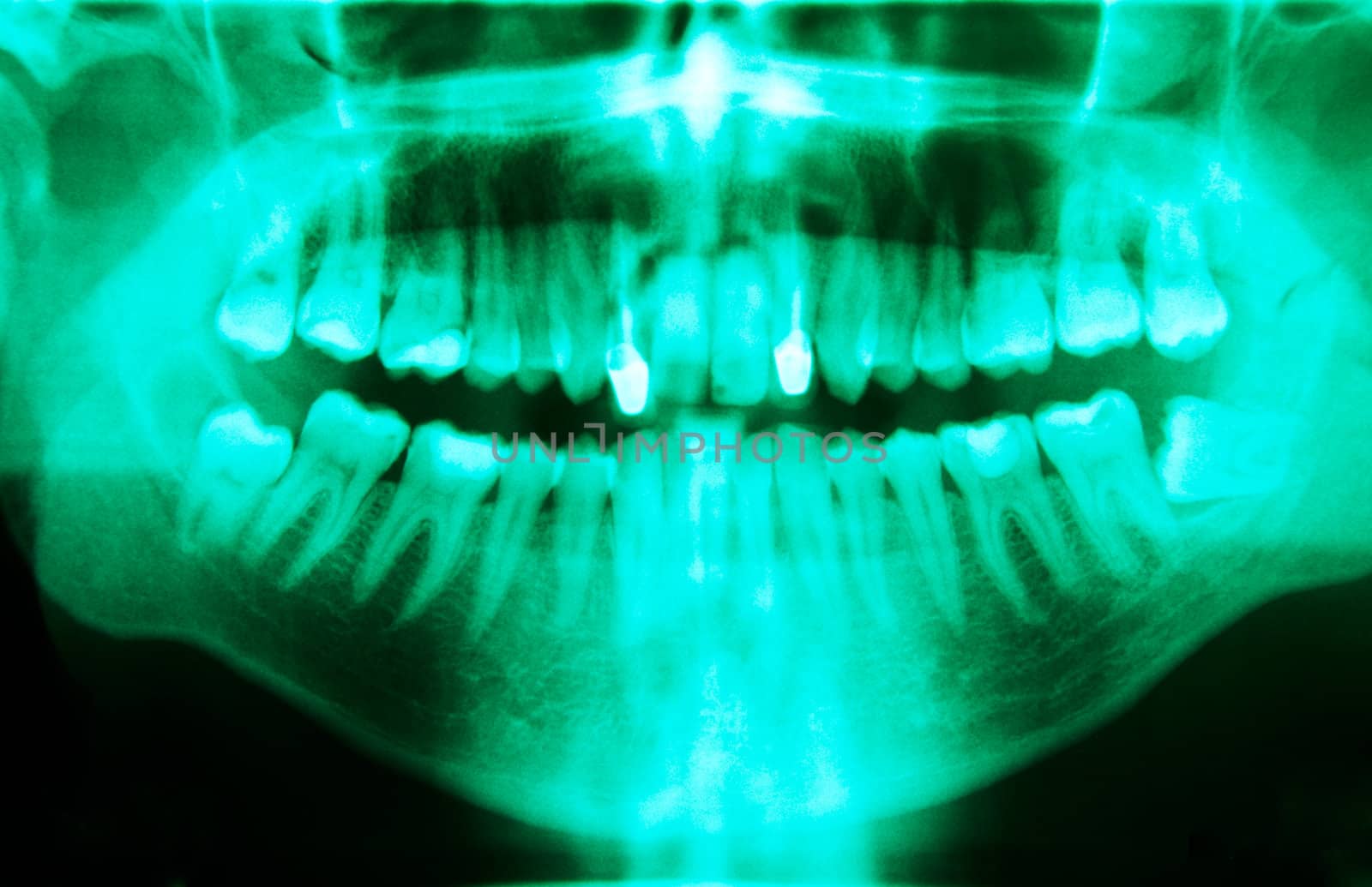 Full mouth panoramic in X-ray, showing all the teeth