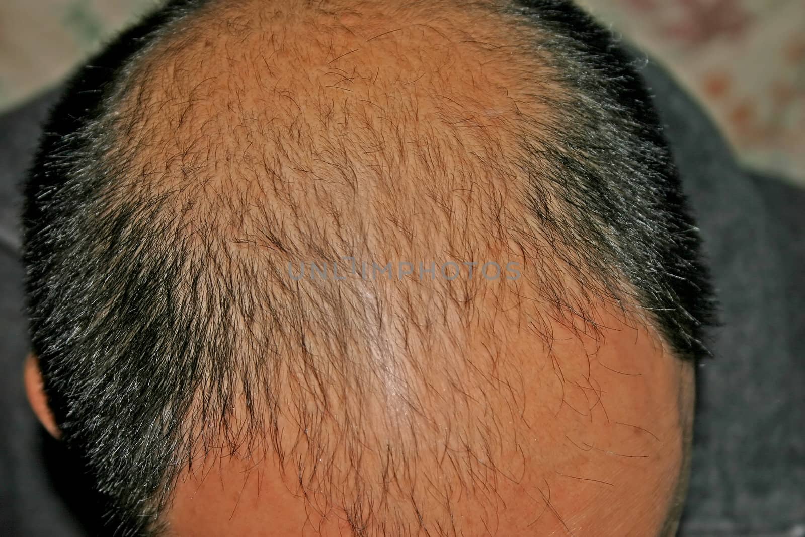 Male Pattern Baldness Bald Head