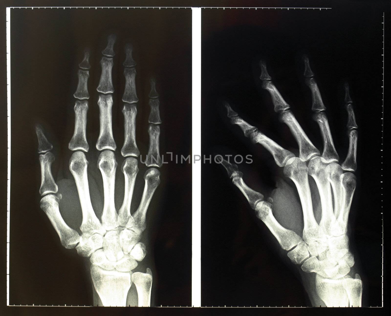 Medical X-Ray imaging of hand fingers used in diagnostic radiology of skeleton bones