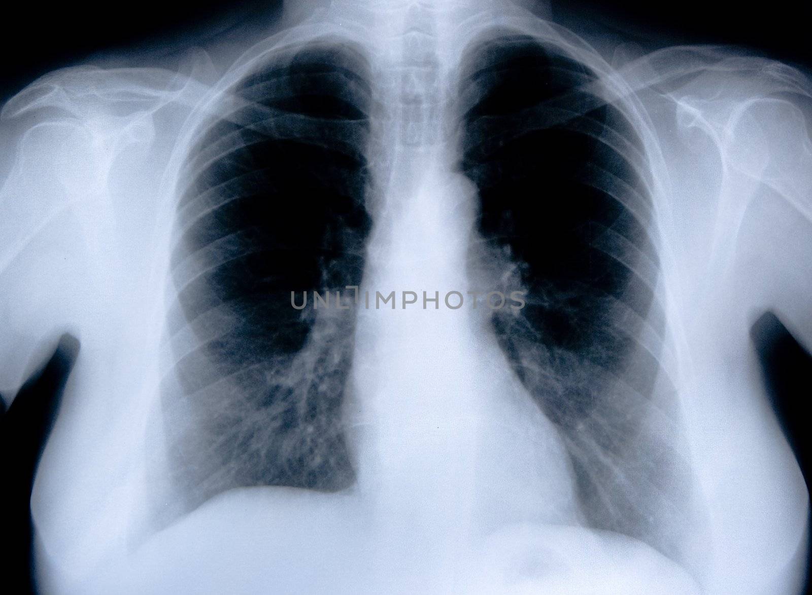 health medical image of an x ray of the chest