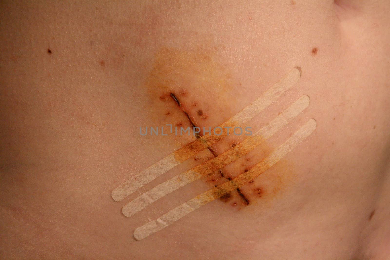 View of the stitches on a cicatrice of a female belly after an appendicitis operation.