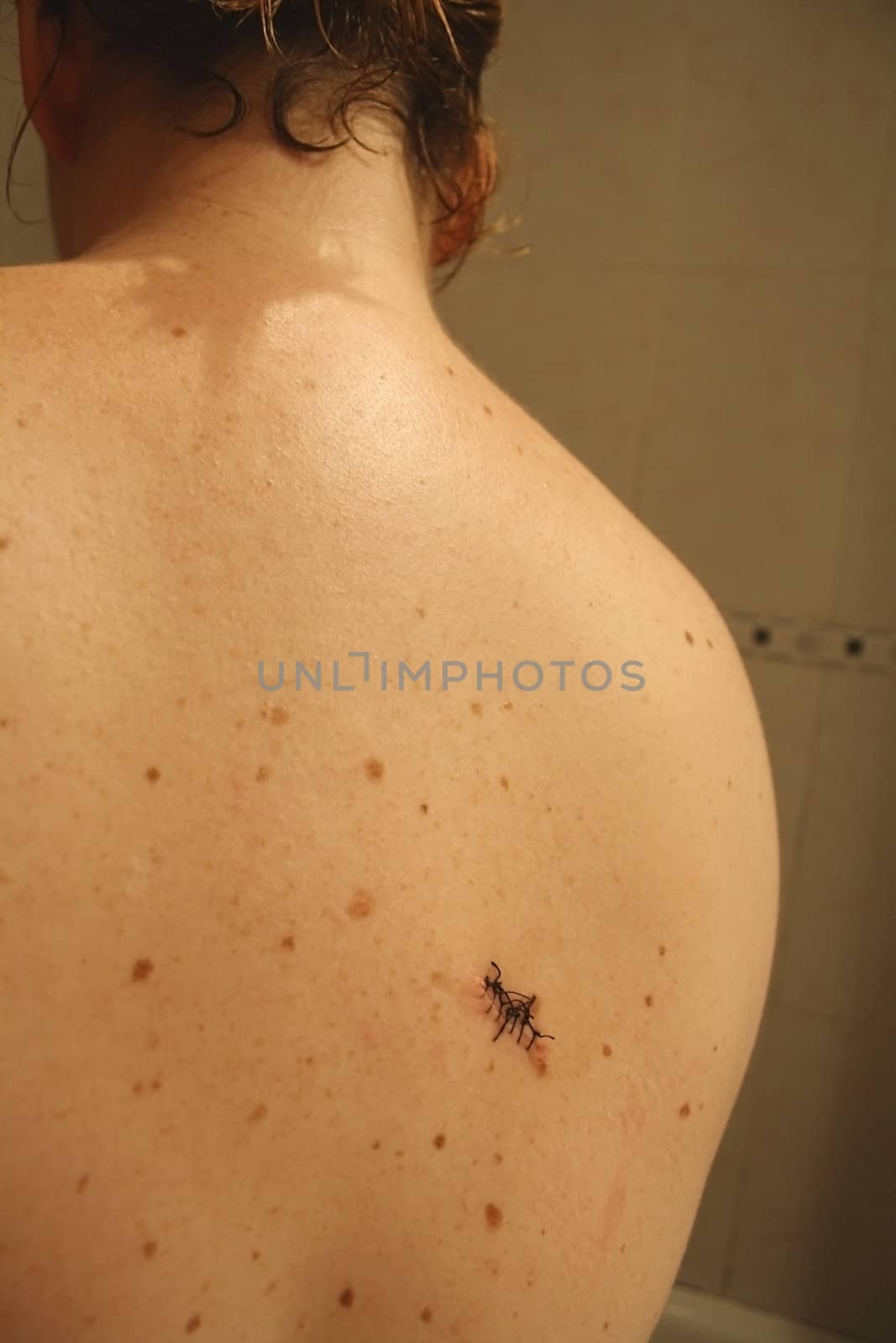 The back of a woman after removing a nevus by surgery.