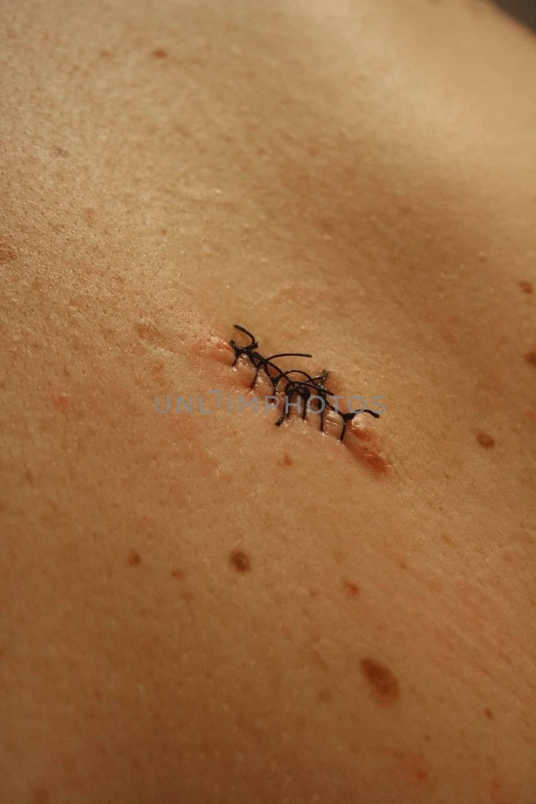 Nevus removed by toneteam