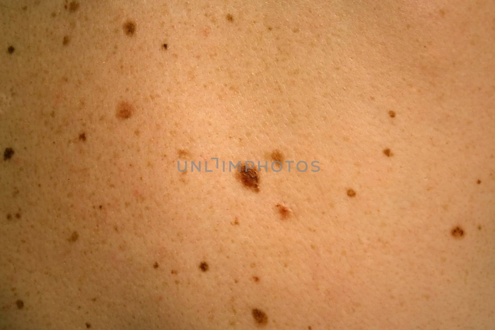 View of a Nevus that needs to be removed.