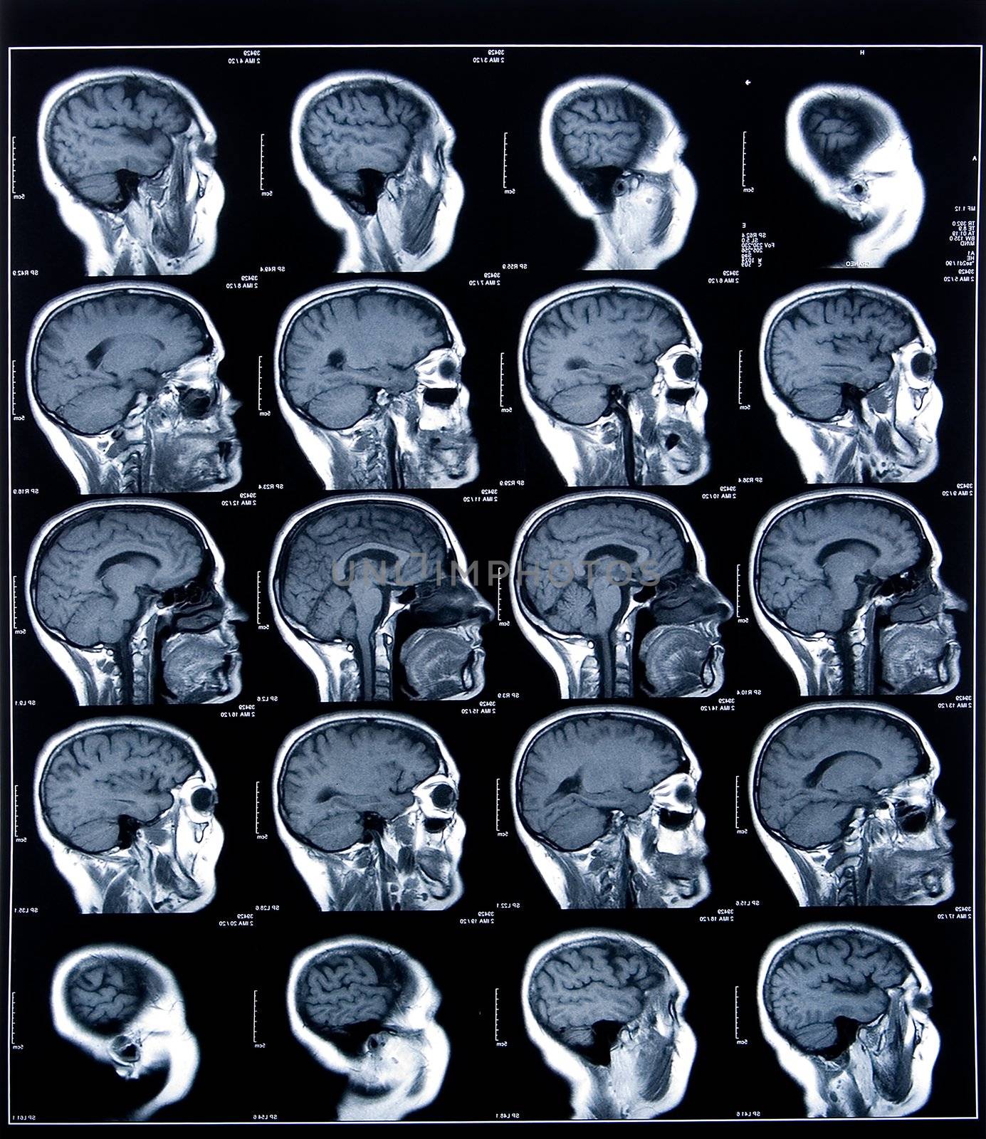 health medical image of an mri of the head showing the brain