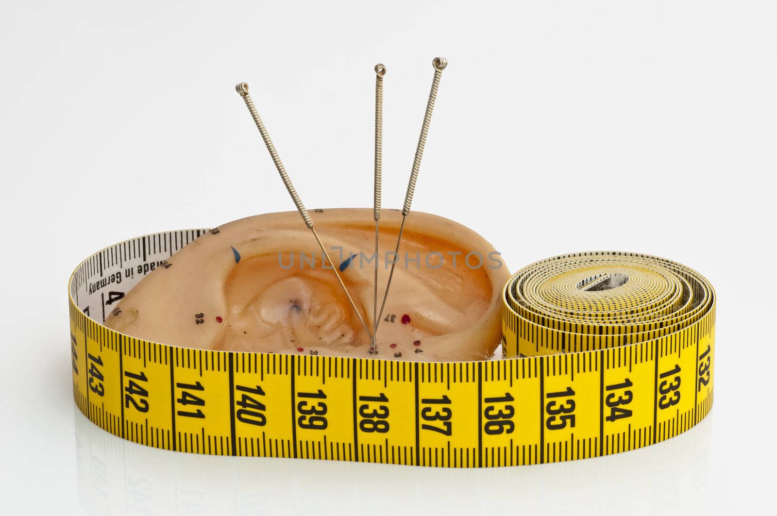 acupuncture for weight loss by Jochen