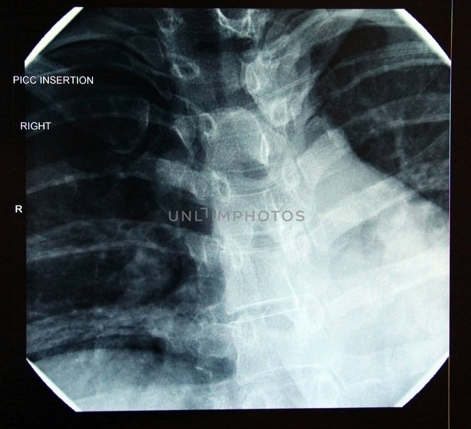 X-ray of correct final PICC (peripherally inserted central catheter) line placement in heart (Female32)