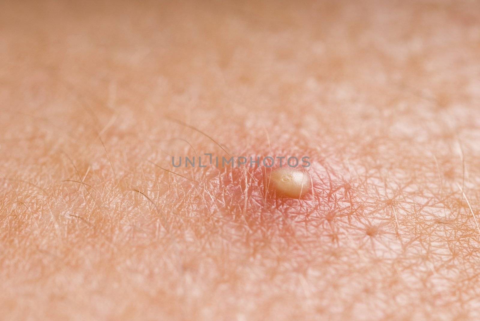 macro image of an ugly white head zit, pictured with a narrow depth of field