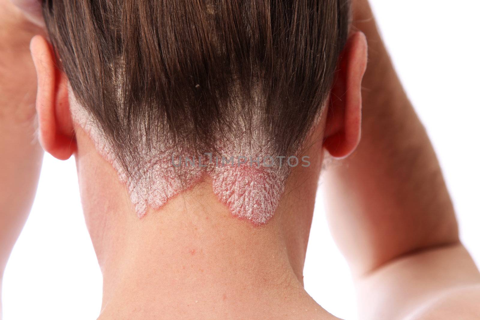 psoriasis on the hairline and on the scalp-close up