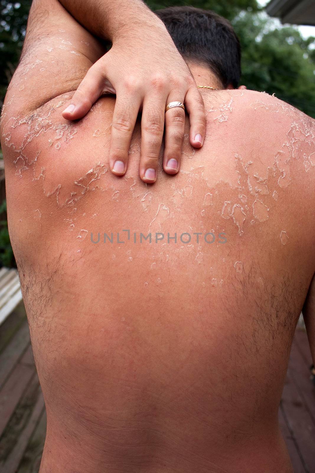 Close up detail of a very bad sunburn showing the peeling blistered skin of a mans back.  Shallow depth of field.