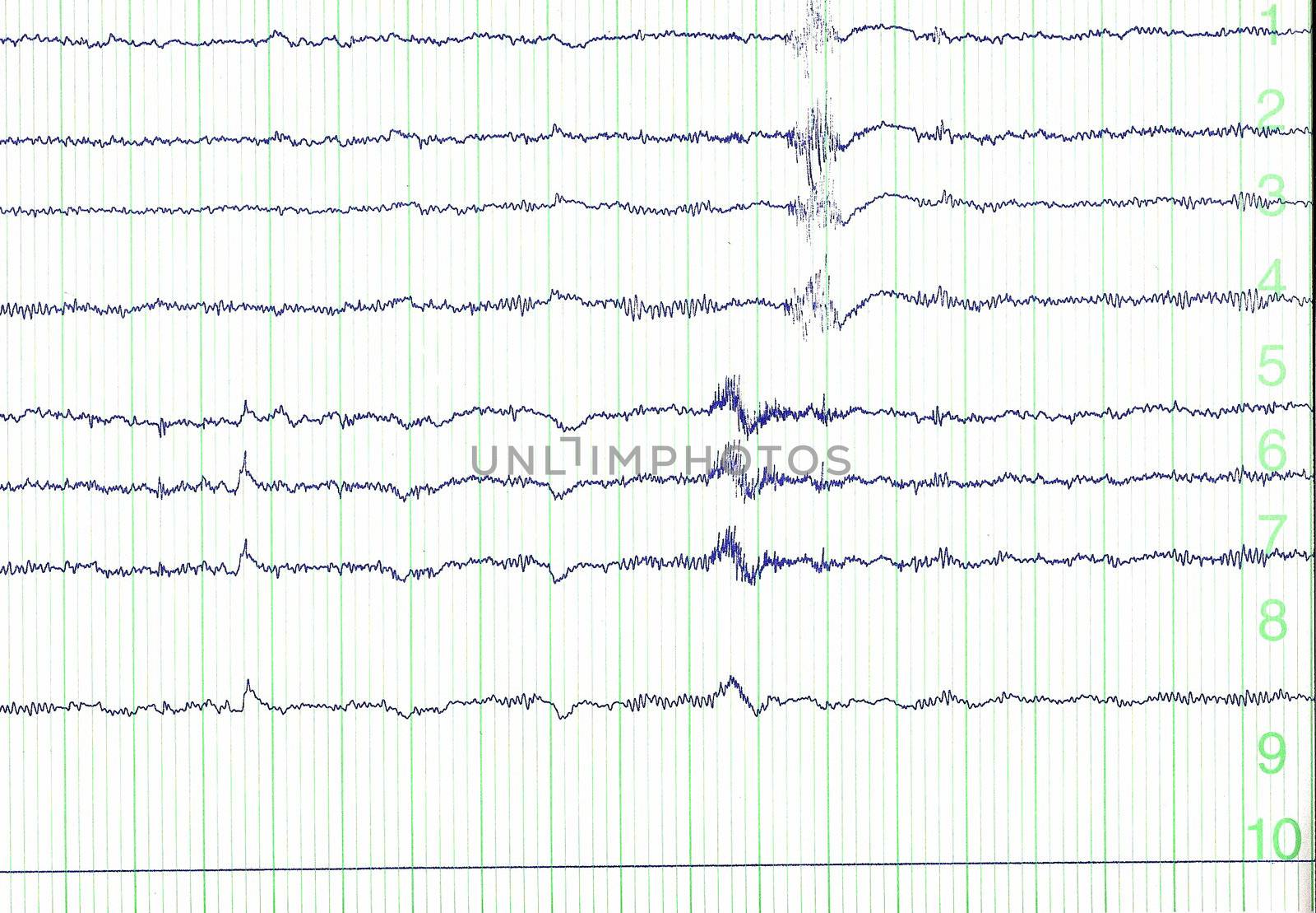 pulse trace of oscilloscope for a electro-encephalogramme (EEG) for search epilepsie 