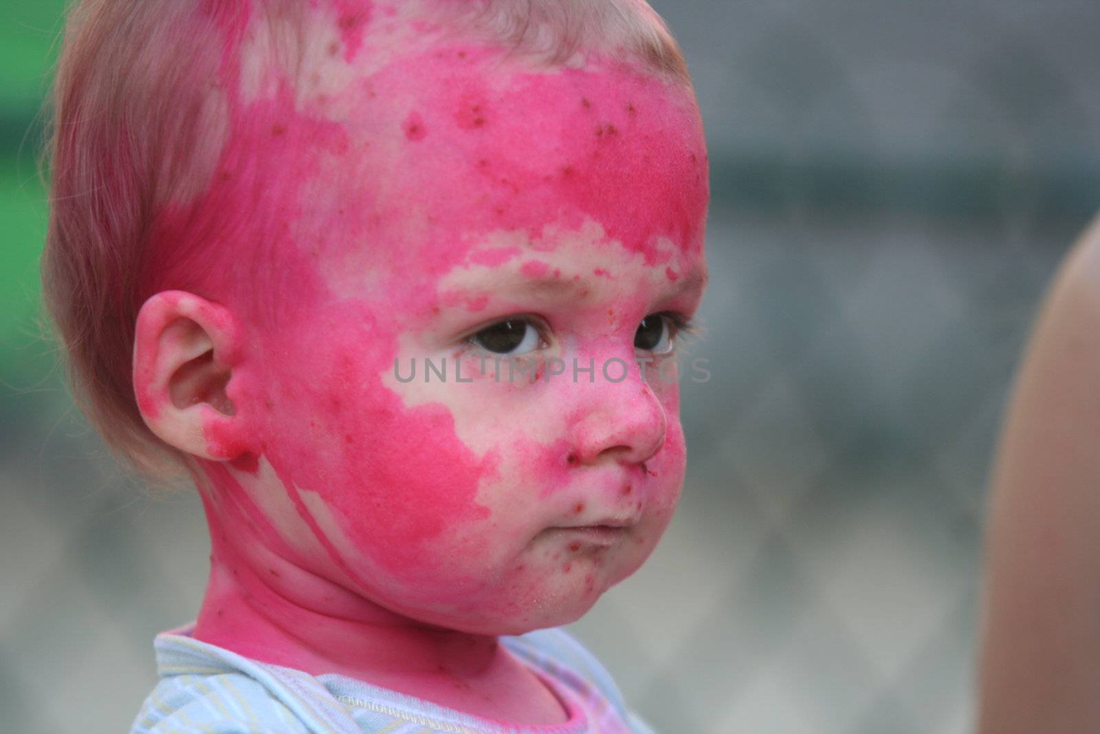 Baby portrait - Chickenpox