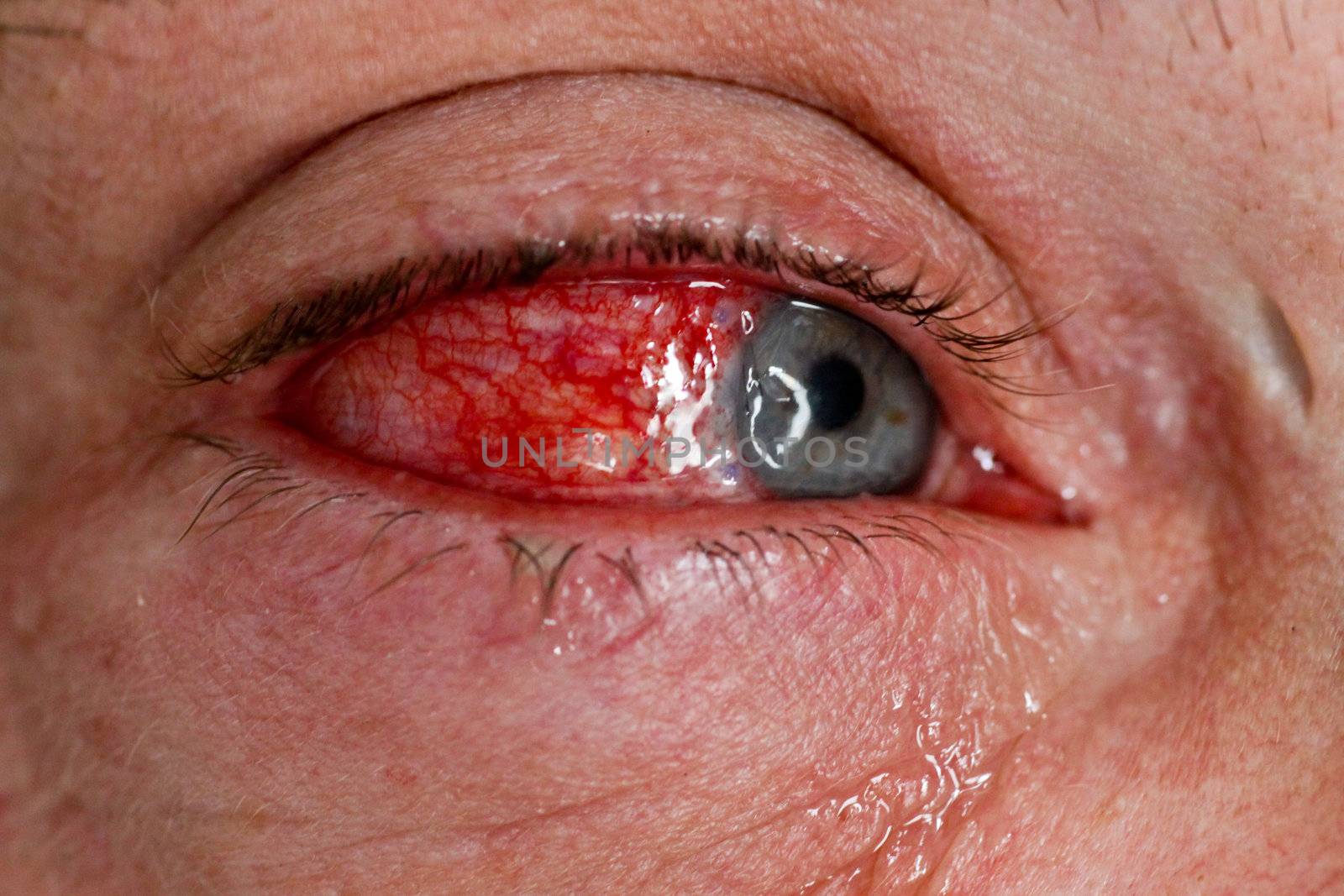 severe eye injury with blood running eye - close-up
