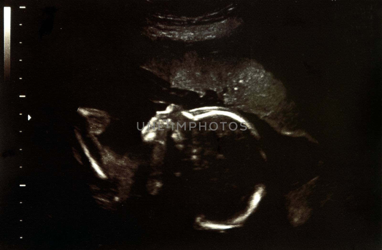 Ultrasound scans during pregnancy in the twentythird week