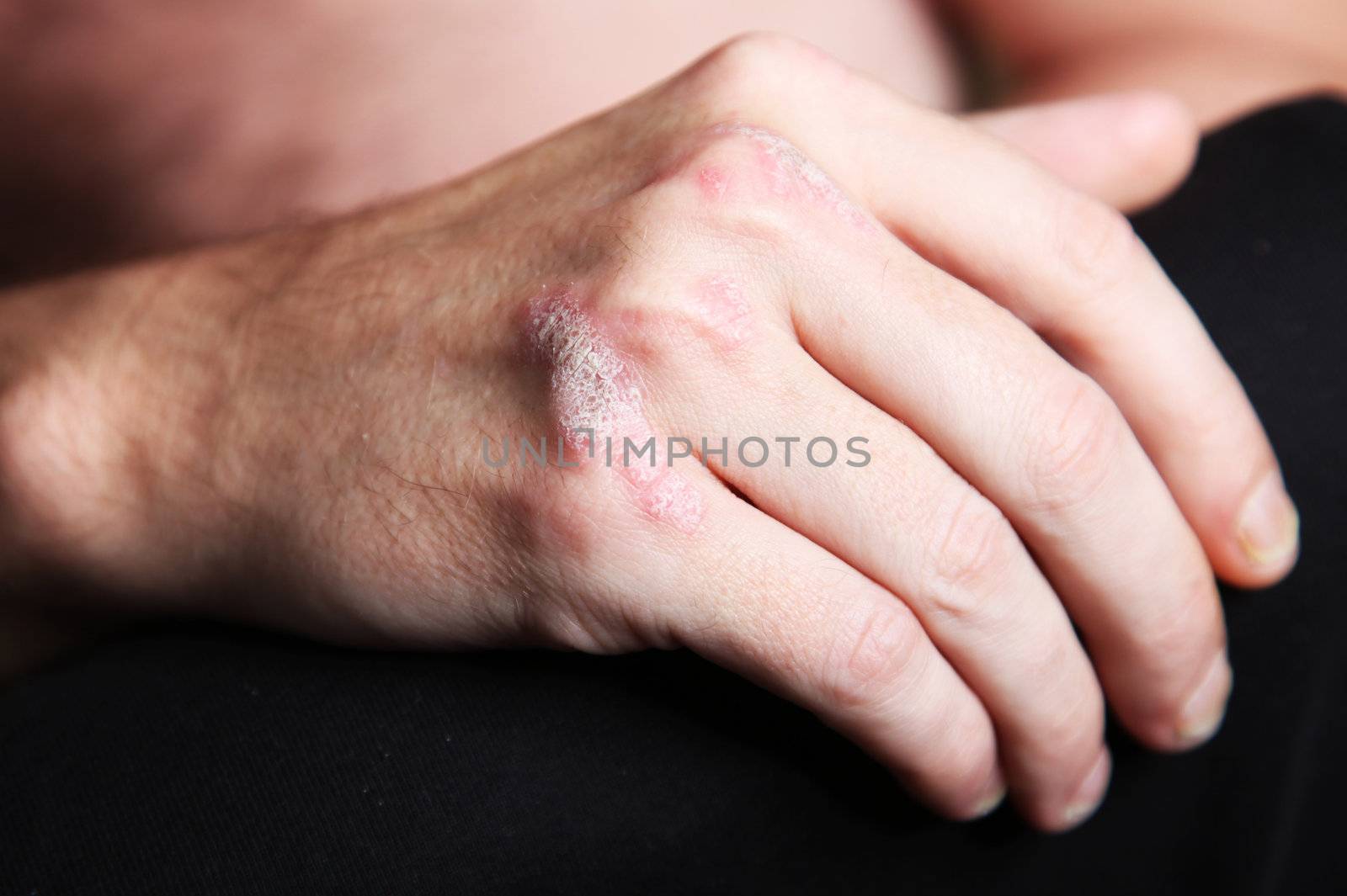 Severe  psoriasis on the hand - close-up
